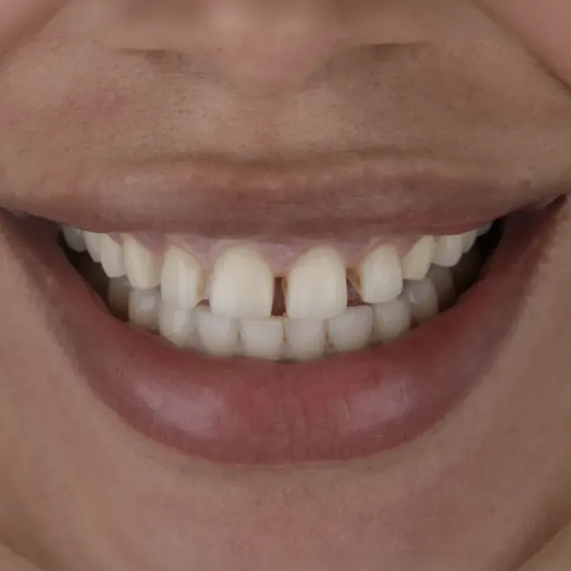 Antes
