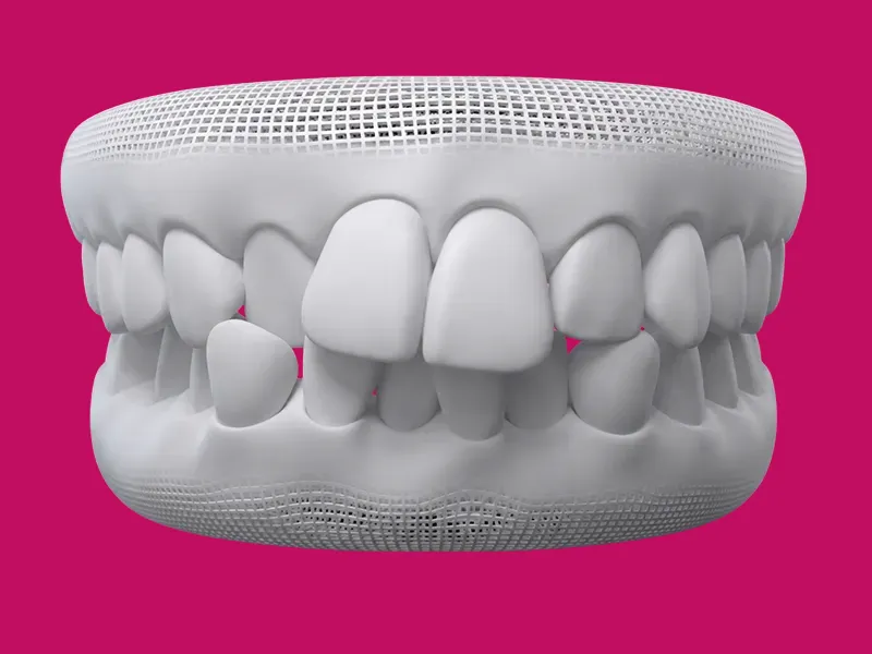 Dientes apiñados