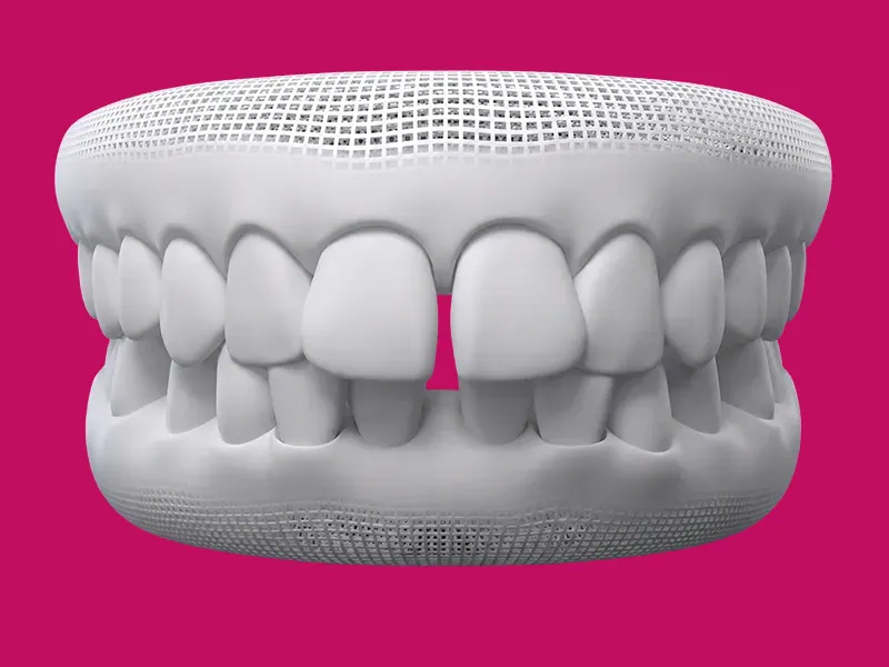 Diastema