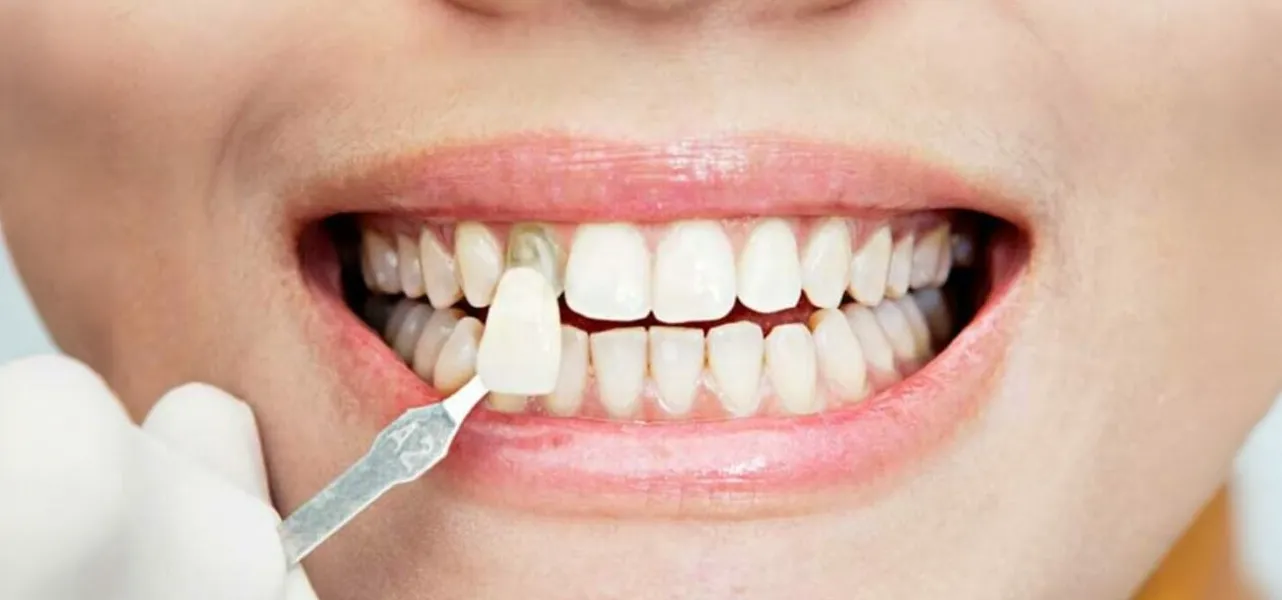 Estética dental