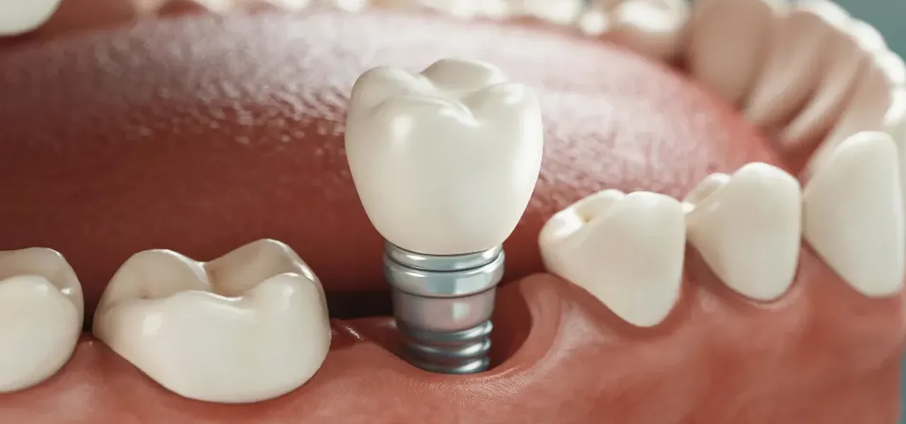 Implantes dentales